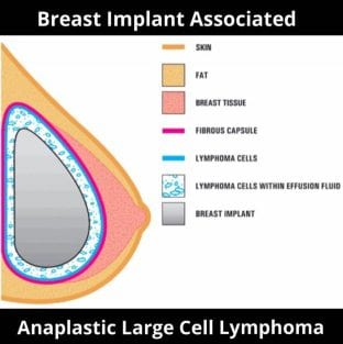 Breast Implant Associated Anaplastic Large Cell Lymphoma Diagram